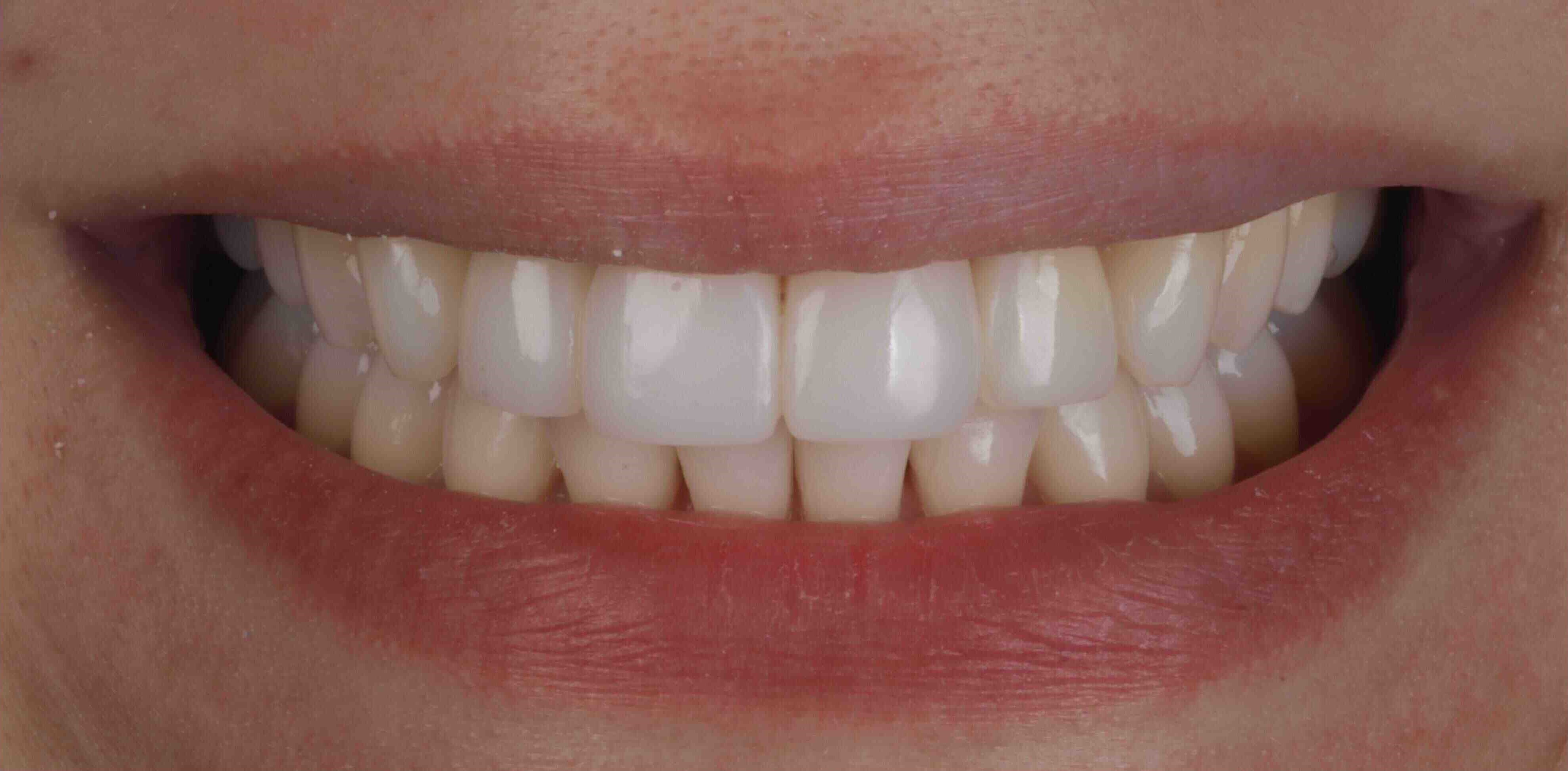 Invisalign and whitening transformation